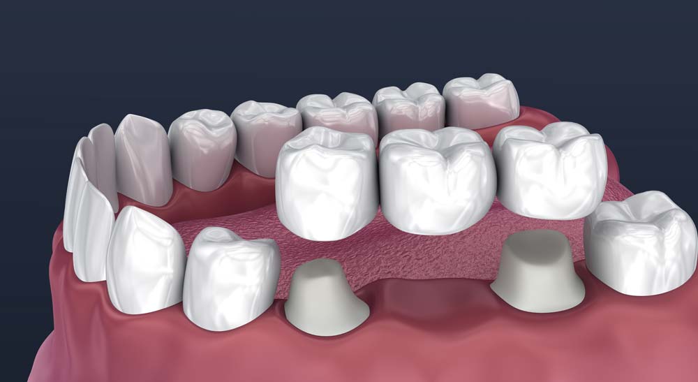 Dental Bridge Illustration