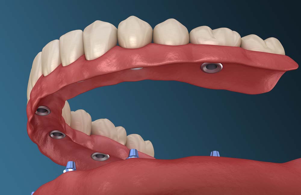 Implant Supported Dentures