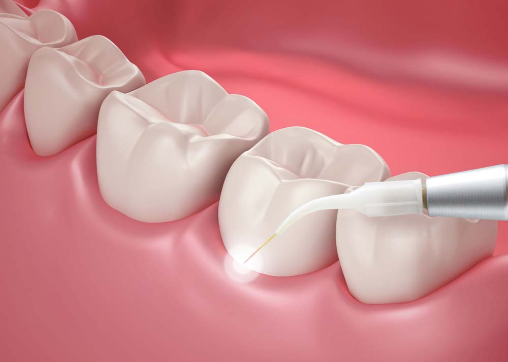 Laser Dentistry Illustration