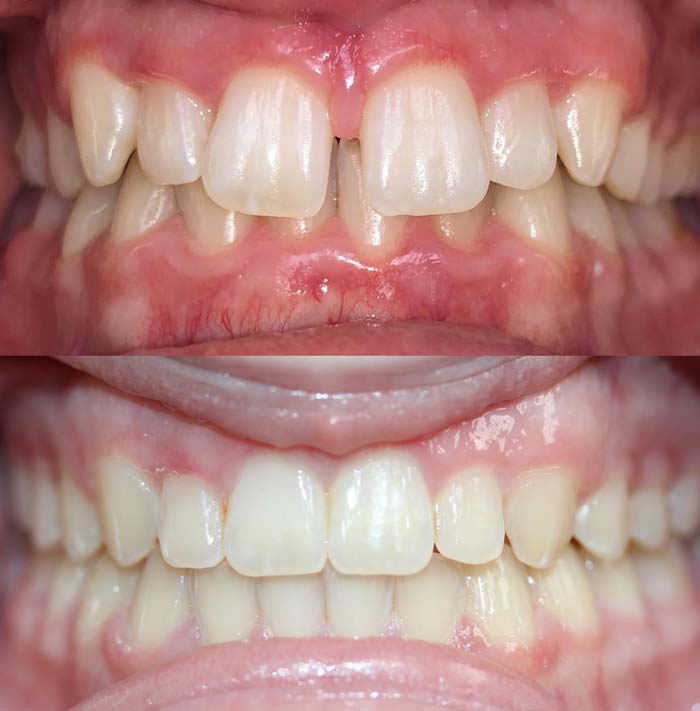 Orthodontic Treatment Before & After Patient