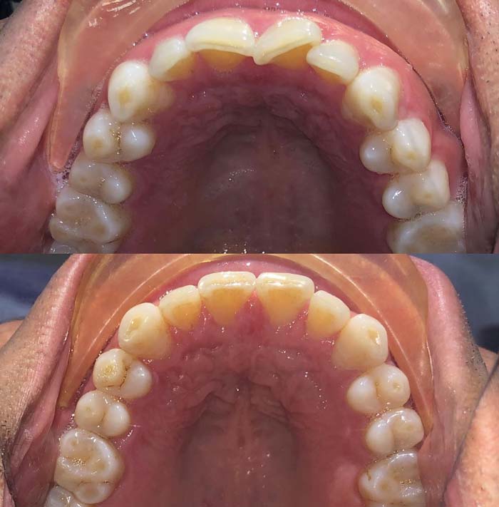 Orthodontic Before & After Patient