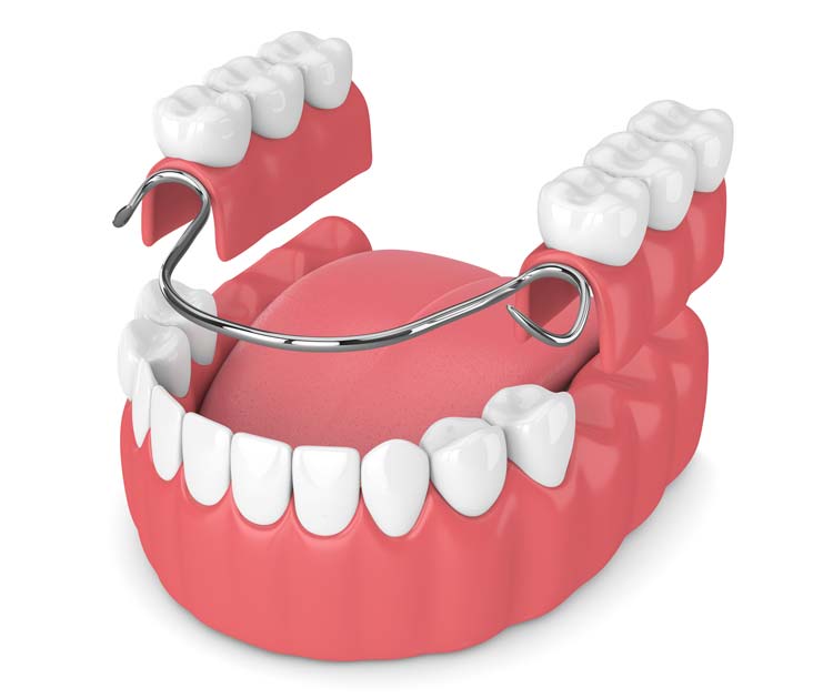 Partial Denture Illustration