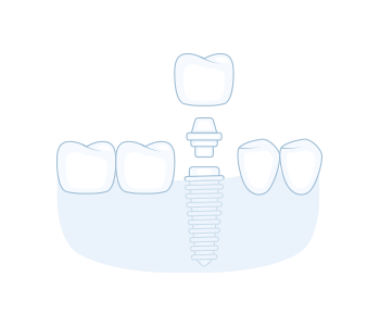 Single Dental Implant Illustration