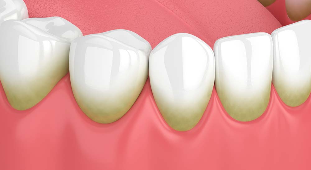 Starting of Gum Disease Illustration