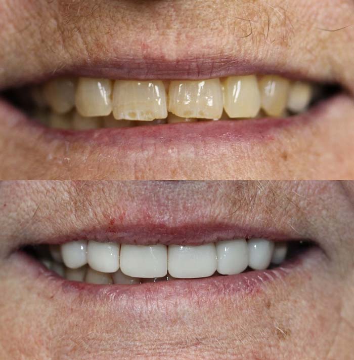 Before & After Dental Veneers