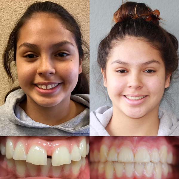 Before & After Orthodontic Treatment