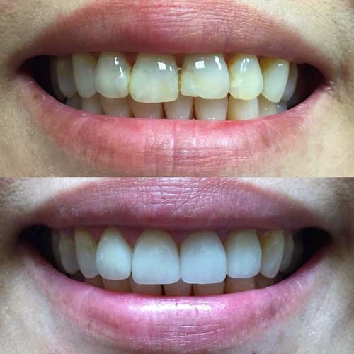 Before & After Porcelain Veneers & Crowns