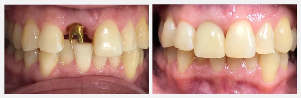 Dental Implants Patient Before & After