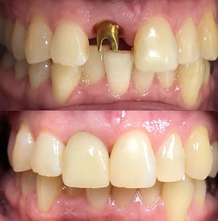 Dental Implant Before & After Patient Smile