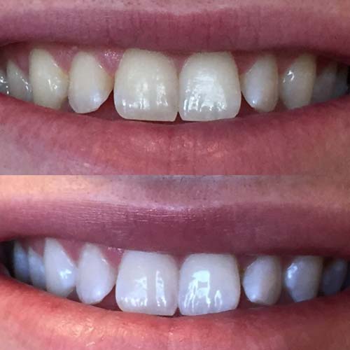 Patient Teeth Whitening Before & After